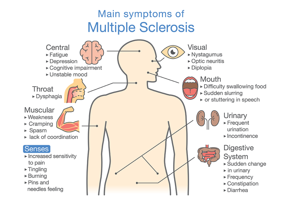 Symptoms of multiple sclerosis.